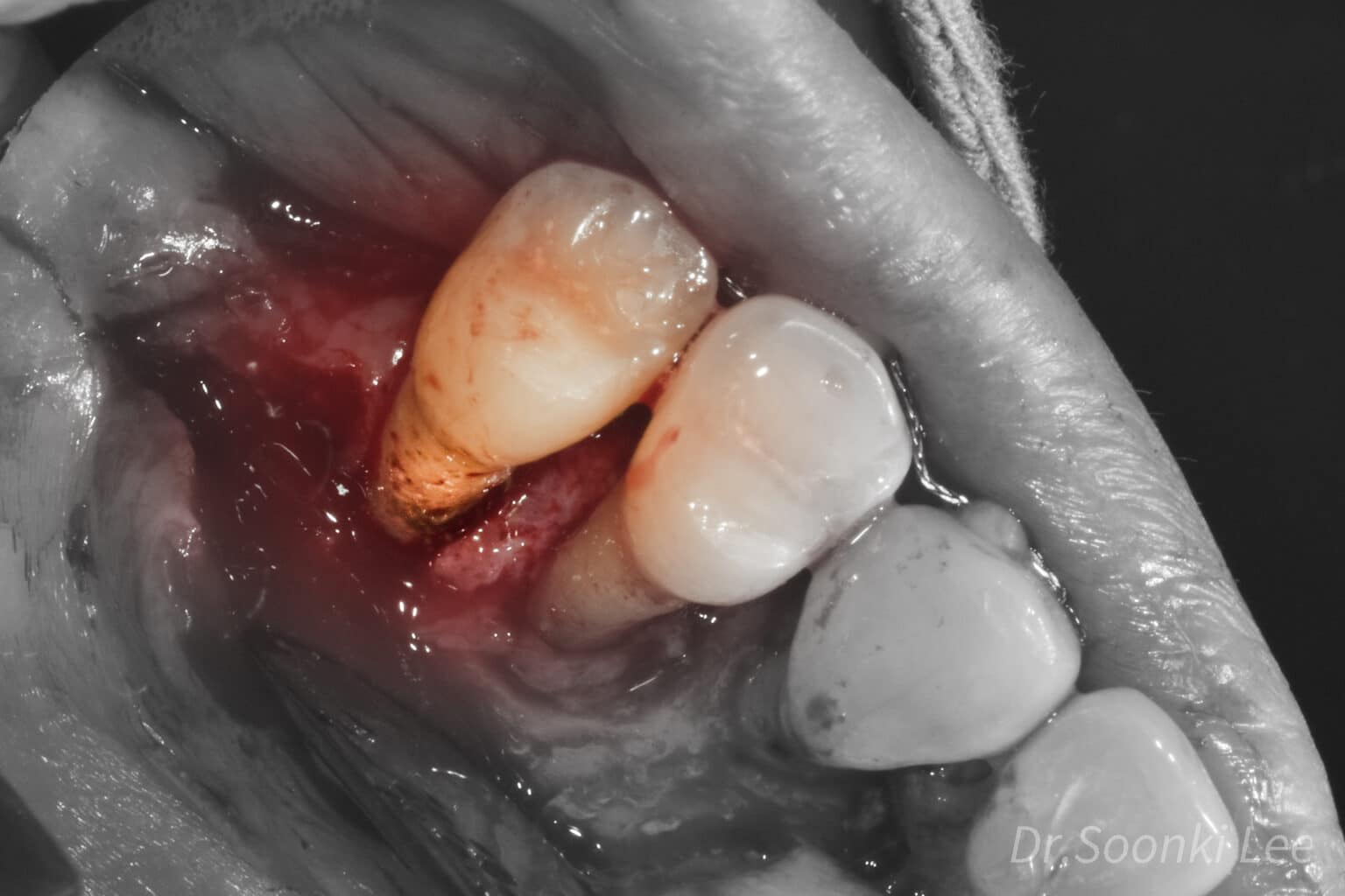 Why Deep Cleaning California Dentistry And Braces
