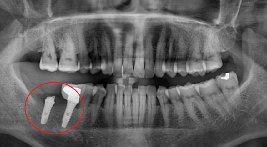 Intraoral view of fractured abutment, photo 1