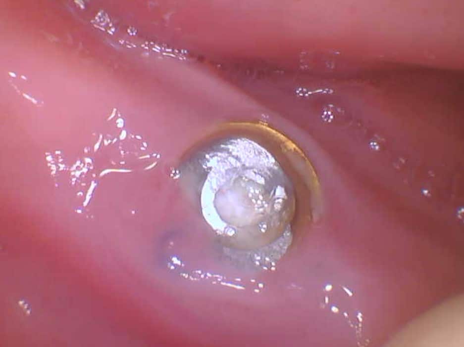Intraoral view of fractured abutment, photo 2