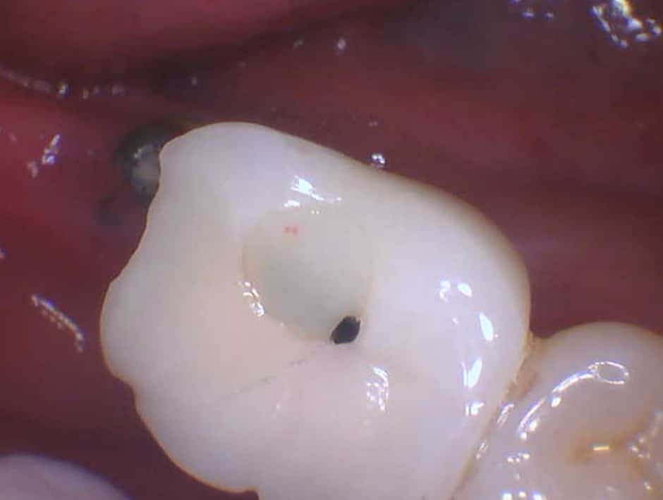 Intraoral view of fractured abutment, photo 3